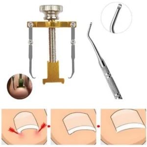 Kit Correttore Riparatore per Unghie Incarnite + Asta Pedicure